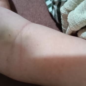 Bebek Hastaya Damar Yolu Açılamadı Personel Deneyimsizliği Mağduriyet Yaşattı