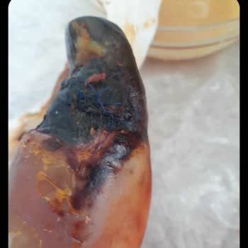 İş Kazası Sonrası Hastanede Kayıt Ve Tedavi Eksikliği Nedeniyle Kalıcı Sakatlık