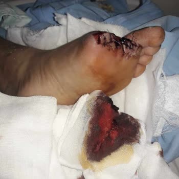 İş Kazası Sonrası Hastanede Kayıt Ve Tedavi Eksikliği Nedeniyle Kalıcı Sakatlık