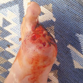 İş Kazası Sonrası Hastanede Kayıt Ve Tedavi Eksikliği Nedeniyle Kalıcı Sakatlık