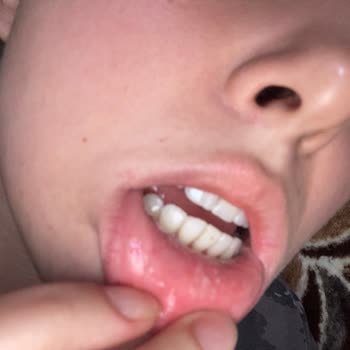Sensodyne Diş Macunu Kullanımı Sonrası Dudakta Şişlik Ve Acı