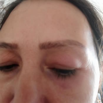 Alerjik Reaksiyona Rağmen Göz Kremi İadesi Reddedildi, Mağdur Edildim