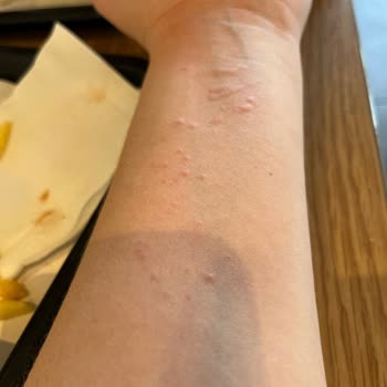 Tavuk Burger Sonrası Yaşanan Alerjik Reaksiyon Ve Hijyen Endişesi