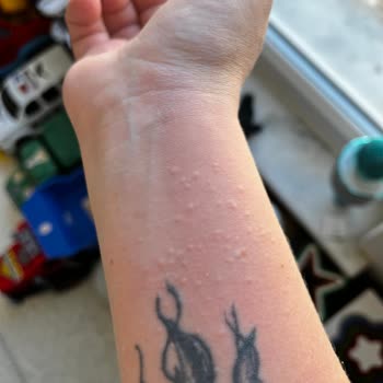 Tavuk Burger Sonrası Yaşanan Alerjik Reaksiyon Ve Hijyen Endişesi