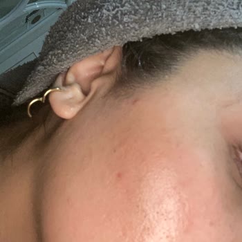 Bioderma Atoderm Nemlendirici Cildimde Ciddi Reaksiyona Sebep Oldu