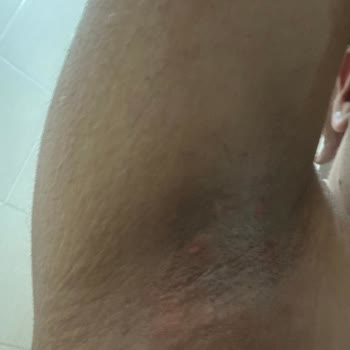 Veet Tüy Dökücü Krem Kullanımında Yanma Ve Destek Eksikliği