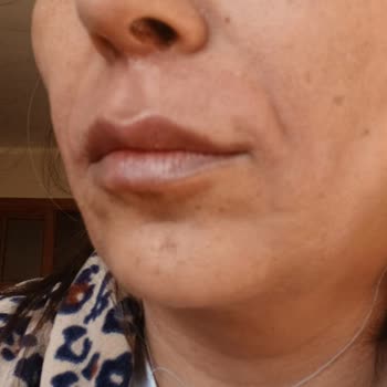 Roxxann Clinic Estetik İşlem Sonrası Mağduriyet Ve Profesyonellikten Uzak Yaklaşım!