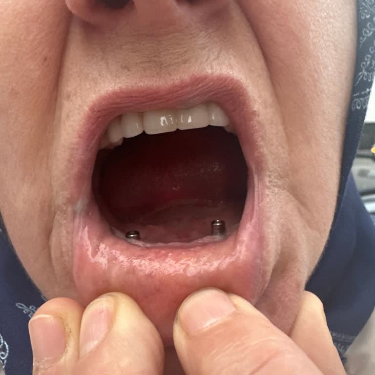 Ümraniye Özbudent'te İmplant Ve Protez Mağduriyeti