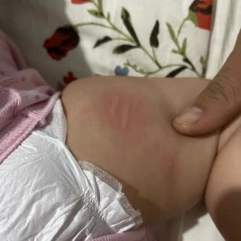 Hero Baby Ek Gıda Sonrası Alerjik Reaksiyon Şoku