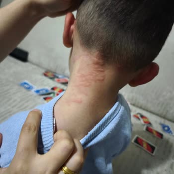 Cici Bebe Bisküvi Sonrası Çocuğumda Ciddi Alerjik Reaksiyon Gelişti