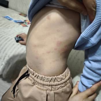Cici Bebe Bisküvi Sonrası Çocuğumda Ciddi Alerjik Reaksiyon Gelişti