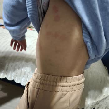 Cici Bebe Bisküvi Sonrası Çocuğumda Ciddi Alerjik Reaksiyon Gelişti