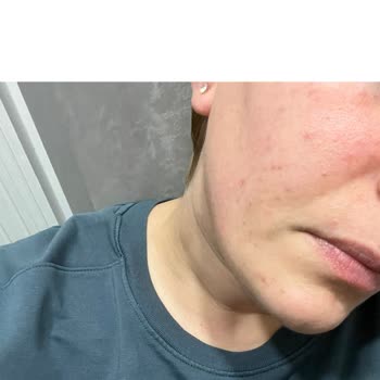 Neutrogena Sivilce Karşıtı Serum Cildimi Bozdu, Müşteri Hizmeti Yetersiz Kaldı