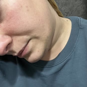 Neutrogena Sivilce Karşıtı Serum Cildimi Bozdu, Müşteri Hizmeti Yetersiz Kaldı