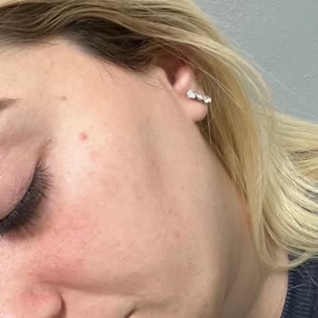 Neutrogena Sivilce Karşıtı Serum Cildimi Bozdu, Müşteri Hizmeti Yetersiz Kaldı