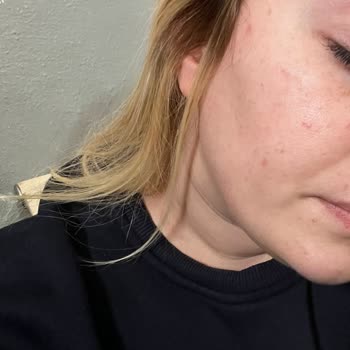 Neutrogena Sivilce Karşıtı Serum Cildimi Bozdu, Müşteri Hizmeti Yetersiz Kaldı