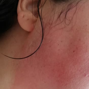 Loreal Paris Leke Karşıtı Krem Ciddi Yanma Ve Kızarıklık Yaptı Mağduriyet Yaşıyoruz