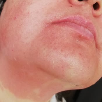 Loreal Paris Leke Karşıtı Krem Ciddi Yanma Ve Kızarıklık Yaptı Mağduriyet Yaşıyoruz