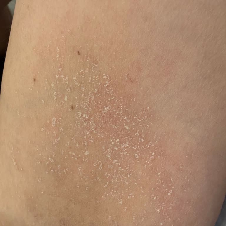 Rexona Roll-On Kullanımı Sonrası Ciltte Kuruluk Ve Kaşıntı Sorunu