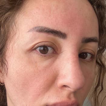 Etkisiz Botoks Ve Dolgu İşlemi Sonrası Mağduriyet Ve Tehditkar Yaklaşım