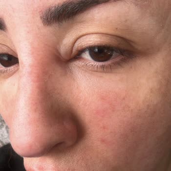 Etkisiz Botoks Ve Dolgu İşlemi Sonrası Mağduriyet Ve Tehditkar Yaklaşım