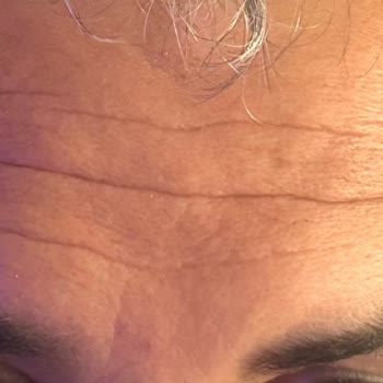 Etkisiz Botoks Ve Dolgu İşlemi Sonrası Mağduriyet Ve Tehditkar Yaklaşım