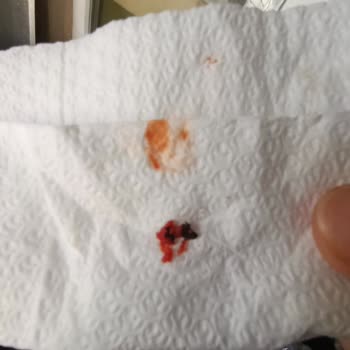 Akfa Salça Kavanozunda Yabancı Cisimle Karşılaşma Ve Sağlık Riski Endişesi