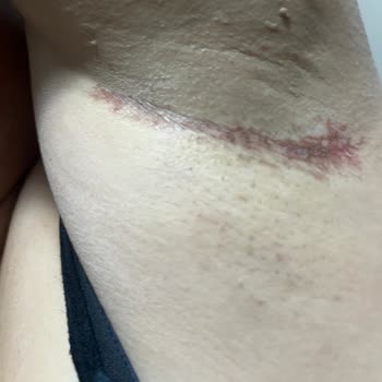 Yves Rocher Roll On İlk Kullanımda Ciddi Cilt Reaksiyonu Ve Kalıcı Leke Endişesi