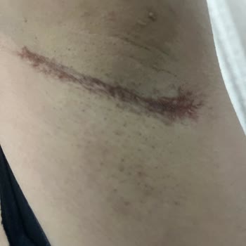 Yves Rocher Roll On İlk Kullanımda Ciddi Cilt Reaksiyonu Ve Kalıcı Leke Endişesi