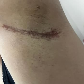 Yves Rocher Roll On İlk Kullanımda Ciddi Cilt Reaksiyonu Ve Kalıcı Leke Endişesi