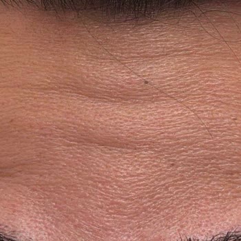 Dr. Figen Health & Beauty Botoks Hiç Tutmadı