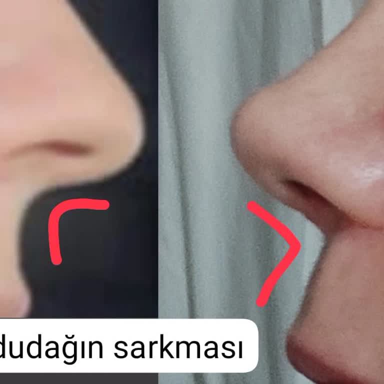Başarısız Burun Ameliyatı Sonrası Kızımın Yüzünde Kalıcı İzler Ve Ciddi Deformasyonlar Oluştu