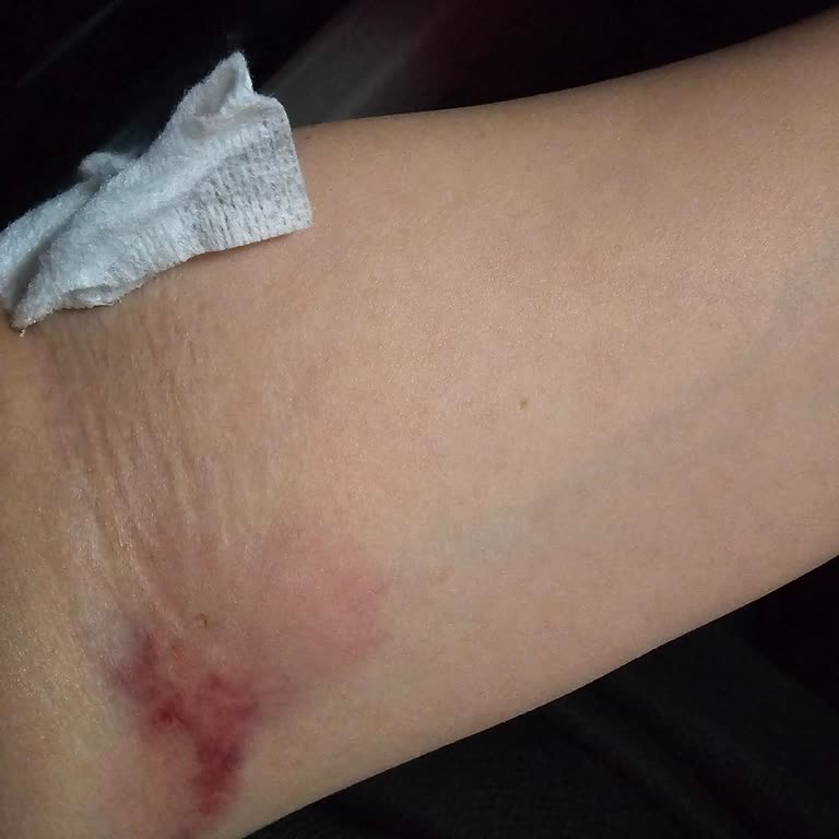 Bingöl Devlet Hastanesi Acil Serviste Stajyer Hemşirenin Hatalı Damar Yolu Açması