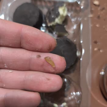 Pişmaniyeden Cam Parçası Çıktı, Sağlığım Tehlikeye Girdi!