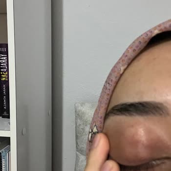 Adaderm Krem Yüzümde Şiddetli Yanma Ve Kızarıklık Yaptı