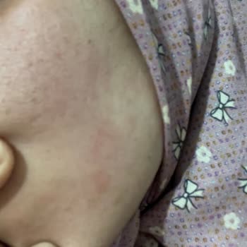 Adaderm Krem Yüzümde Şiddetli Yanma Ve Kızarıklık Yaptı