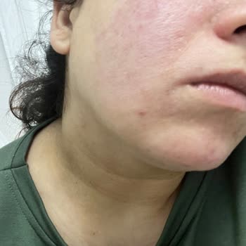 Garnier Hyaluronik Aloe Temizleyici Cildimde Şiddetli Yanma Ve Kızarıklığa Sebep Oldu