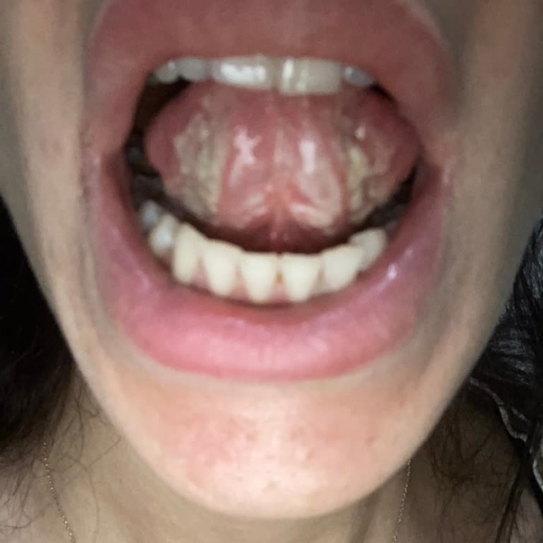 Ağız Bakım Suyu Sonrası Ciddi Rahatsızlık Ve Beyaz Birikintiler