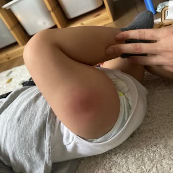 Bebeğimin Aşı Sonrası Enfeksiyon Ve Kaba Davranış Mağduriyeti