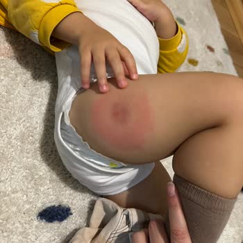 Bebeğimin Aşı Sonrası Enfeksiyon Ve Kaba Davranış Mağduriyeti