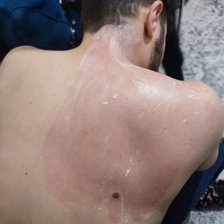 Thermoflex Ağrı Kesici Kremde Ciddi Yan Etki Ve Güvenlik Endişesi