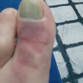 Kaldırımdaki Tehlikeli Rögar Kapağı Nedeniyle Yaşanan Kaza Ve Güvenlik Eksikliği