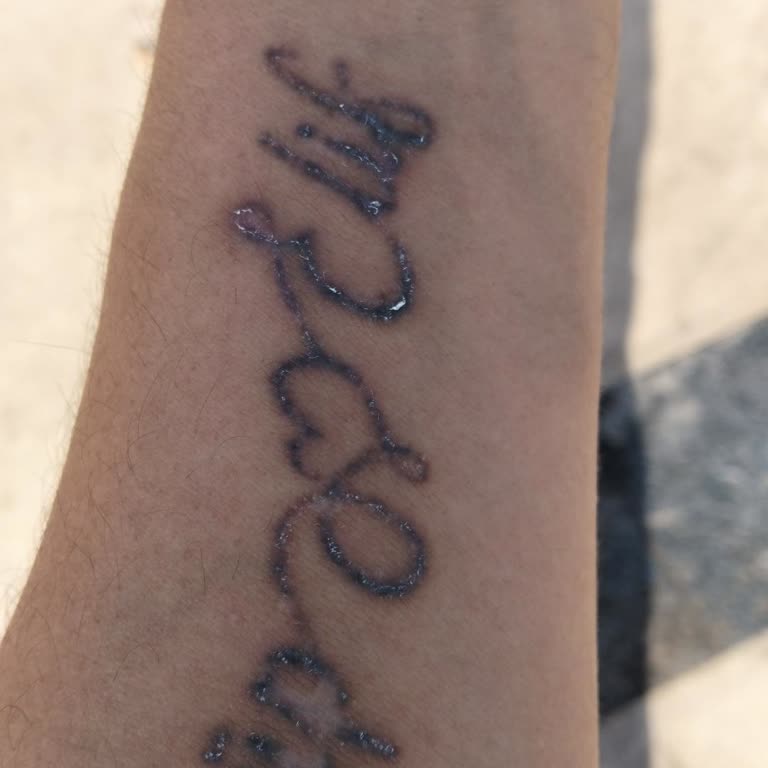 Dövme Silme Merkezinden Verilen Garanti Tutulmadı, Mağdur Edildim