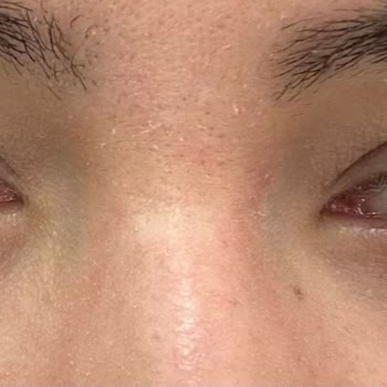 Aktıp Hastanesi Botoks Sonrası Göz Kapağı Düşüklüğü Ve Klinik İlgisizliği