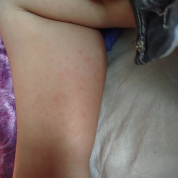 Baby Turco Bebek Bezi Kızarıklık Ve Cilt Sorunu Yaşattı