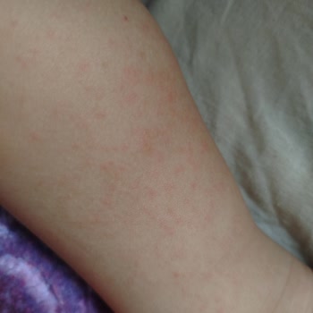 Baby Turco Bebek Bezi Kızarıklık Ve Cilt Sorunu Yaşattı