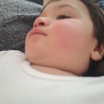 Alerjik Çocuğumda Bioderma ABC Şampuanı Ciddi Cilt Reaksiyonu Yarattı