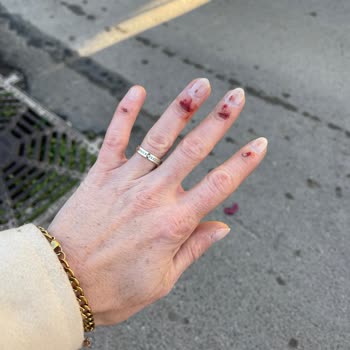 Martı Elektrikli Bisikletin Fren Arızası Nedeniyle Yaşanan Ciddi Kaza Ve Yaralanma