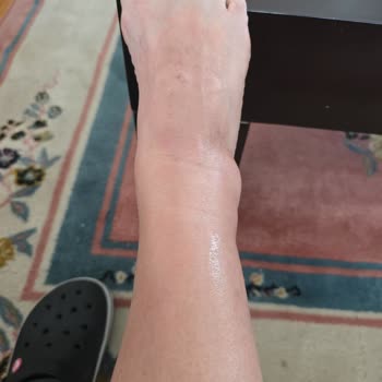 Sağlığımı Tehdit Eden Bot Ve Satıcı İlgisizliği Nedeniyle Mağduriyet