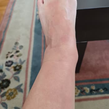 Sağlığımı Tehdit Eden Bot Ve Satıcı İlgisizliği Nedeniyle Mağduriyet